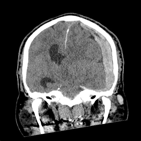 Subdural Hematoma Uncal Herniation And Duret Brainstem Hemorrhage