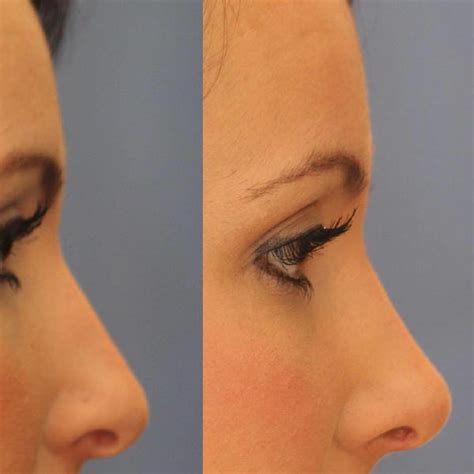 Bulbous Tip Nose Before And After Nose Reshaping Rhinoplasty Cost