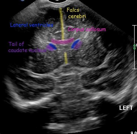 Fetal Head Anatomy Ultrasound