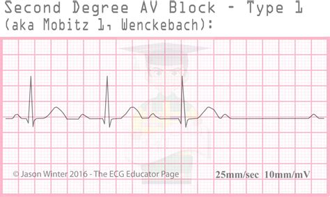 Ecg Educator Blog Heart Blocks