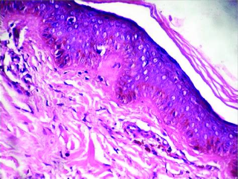 Mild Acanthosis Hyperpigmentation Of Basal Keratinocytes And
