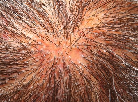 lichen planus scalp symptoms