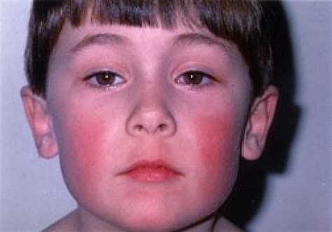 Fifth Disease Erythema Infectiosum Harvard Health