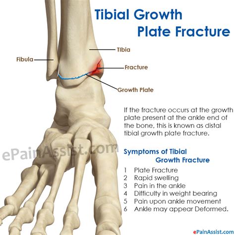 Tibial Growth Plate Fracturesymptomscausestreatment Mri Surgery
