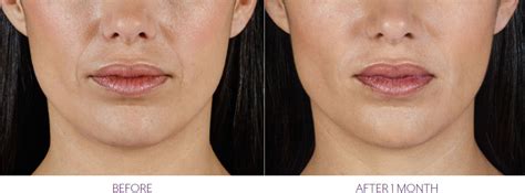 Vollure Filler By Juvederm Vedas Medical Spa And Wellness Center