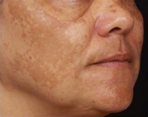 Natural Ways To Treat Acne Scars And Discoloration