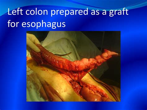 Intestinal anastomoses are commonly performed in both elective and emergent operations. PPT - Gastric stump adenocarcinoma PowerPoint Presentation, free download - ID:4799988