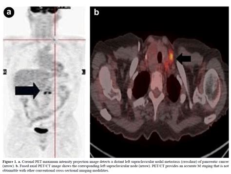 18f Fdg Petct Imaging Of The Pancreas Spectrum Of Diseases