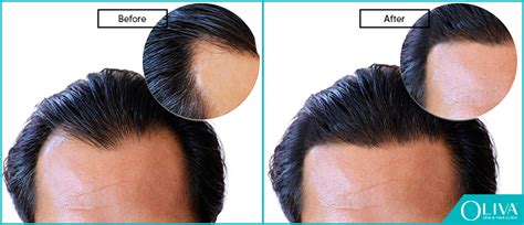 Receding Hairline Causes Treatments And Prevention
