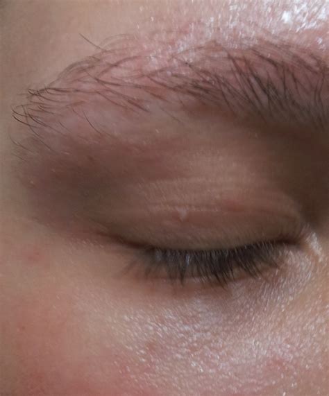 Skin Concern Small White Bump Under Nose Small Bump On Eyelid And