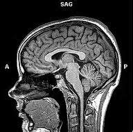 Pediatric brain tumors typically are primary brain tumors — tumors that start in the brain or in tissues close to it. ABCs Of Brain Tumors - Brain-Surgery.com