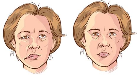 Facial Paralysis Symptoms Causes Treatments What Causes Facial Paralysis Koru Health Group