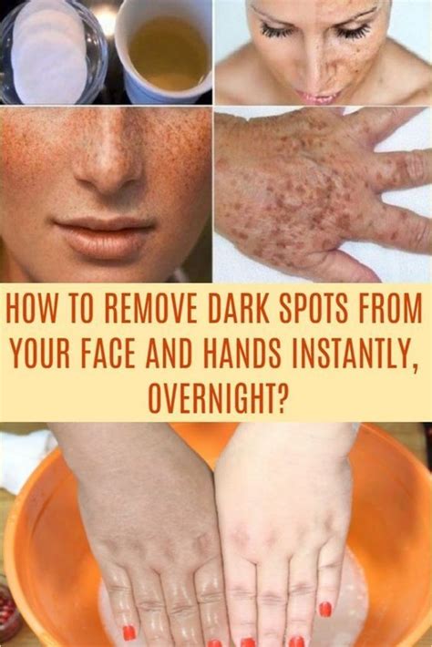Natural Remedies To Remove Warts Dark Spots Blackheads And Skin Tags