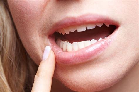 Canker Sores All You Need To Know About Symptoms Treatment Rozenberg