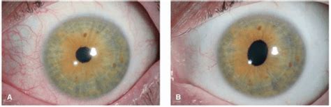 Episcleritis Scleritis And Keratitis Ento Key