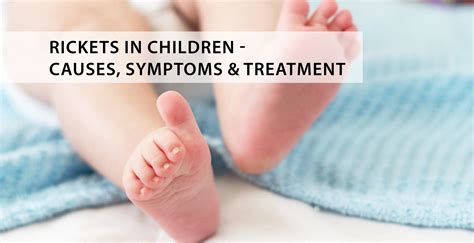 Rickets In Children Causes Symptoms And Treatment