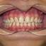 Spacing Of Teeth  Orthodontist Ottawa ON Centrepointe Orthodontics