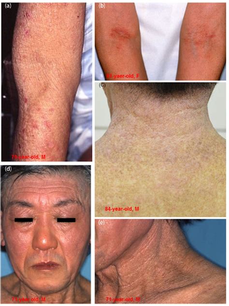 Atopic Dermatitis In Older Adults A Viewpoint From Geriatric