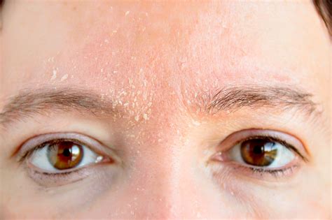 Causas Y Tratamientos Dermatitis Seborréica Skin Expert