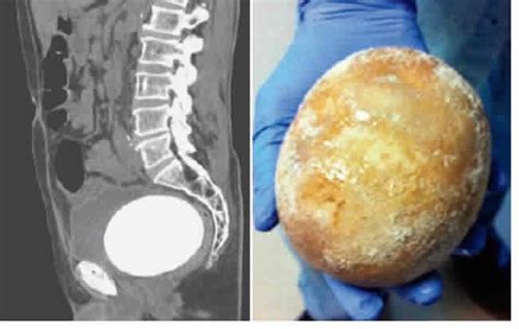Bladder Stones Can Make It Impossible For Men To Urinate Punch Newspapers