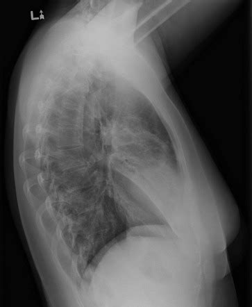 Chest Radiograph Radiology Reference Article Radiopaedia Org