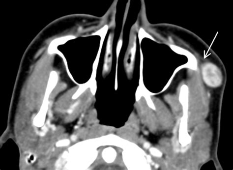 Nodular Fasciitis In The Head And Neck Ct And Mr Imaging Findings