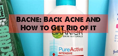 Bacne Back Acne And How To Get Rid Of It Hello Jennifer Helen