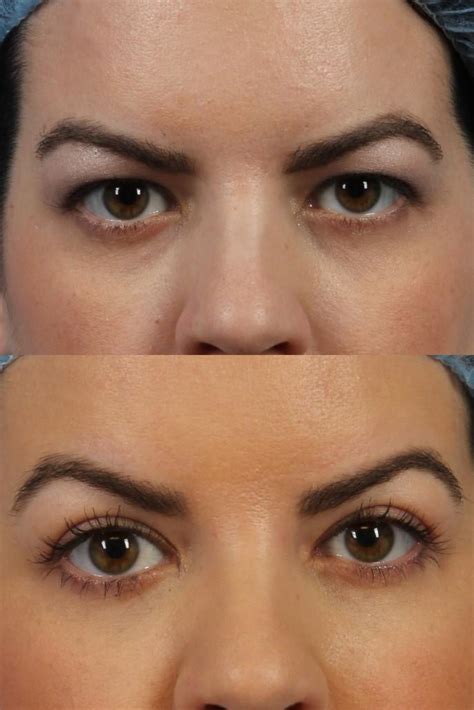 Eyelid Lift Blepharoplasty In Nyc Dr Brett Kotlus