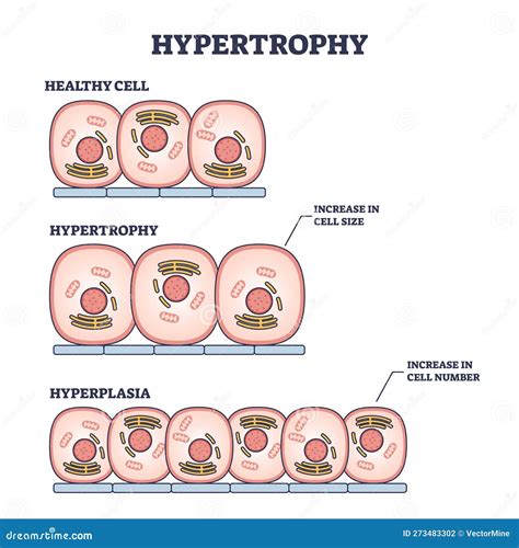 Hypertrophy Hyperplasia Or Healthy Muscular Cells Comparison Outline