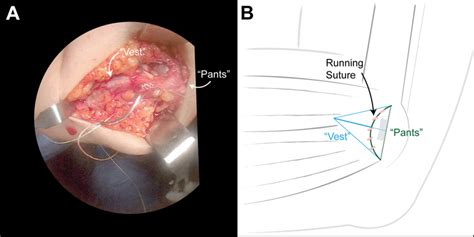 A A Separate Absorbable Suture Is Used To Tie The Edge Of The