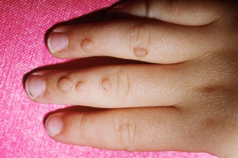 10 Common Skin Rashes In Children