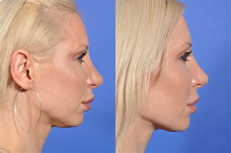 Everything You Should Know About Kybella Treatment