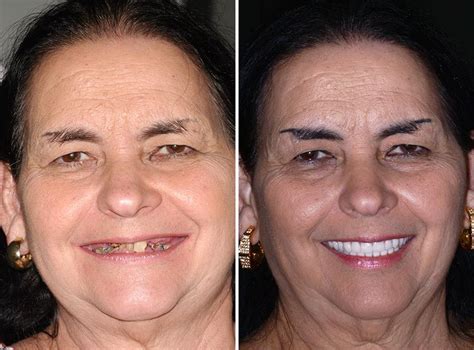 Fotos de Antes y Después de Implantes Dentales All on 4 Pac 62