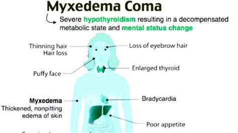 Myxedema Coma Scale