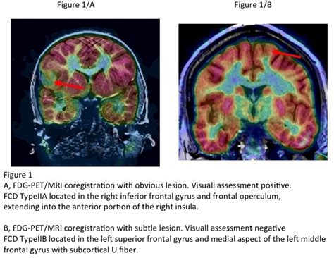 A Potential Pitfall Of Fdg Petmri Coregistration In The Presurgical