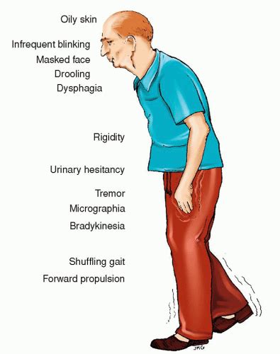 After diagnosis, treatments can help relieve symptoms, but there is no cure. Parkinson's Disease | Nurse Key