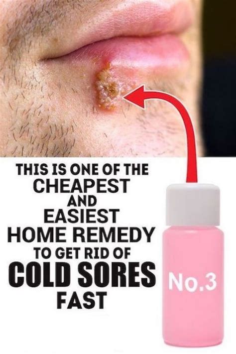 Best Way To Treat A Cold Sore Just For Guide