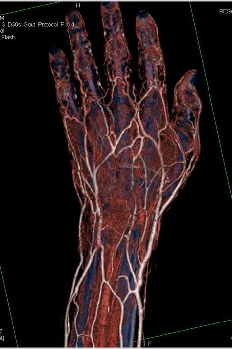 Cellulitis Dorsum Of The Hand Musculoskeletal Case Studies Ctisus