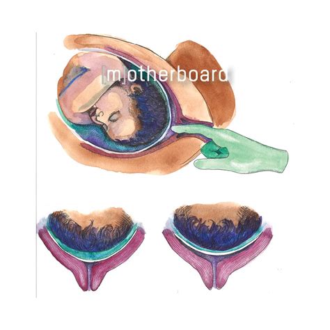 Membrane Sweep — Motherboard Birth