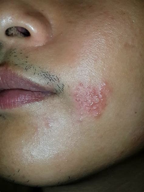 Skin Infected Herpes Zoster Shingles Virus On The Face Cheek Editorial
