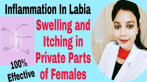 Homeopathic Treatment For Inflammation Swelling Itching In Labia