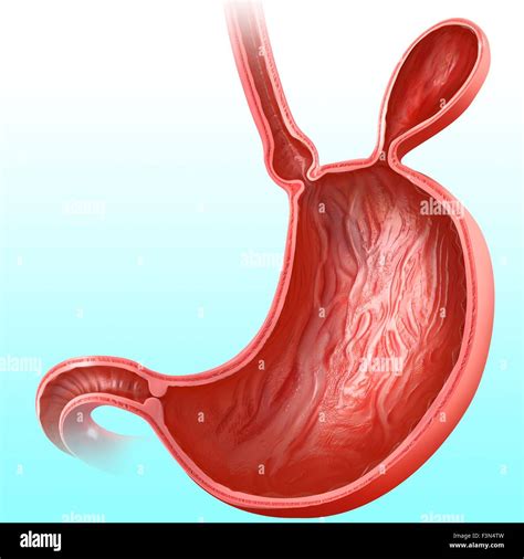 Stomach Hernia Illustration Hi Res Stock Photography And Images Alamy