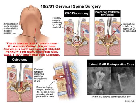 Amicus Illustration Of Amicus Surgery Cervical Anterior Fusion