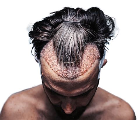 Hair Transplant Without Shaving Risks And Benefits Dr Cinik
