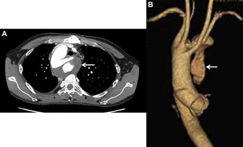 A Subcutaneous Mass As A Sign Of Thoracic Aortic Pseudoaneurysm