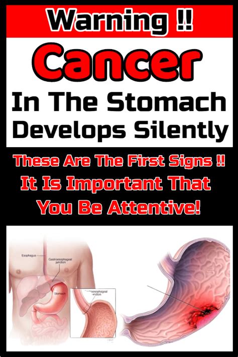 Indigestion and bloating are among the first noticeable symptoms. Cancer In The Stomach Develops Silently. These Are The ...