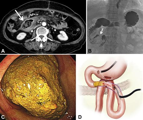 Intraoperative Endoscopic Removal Of A Duodenal Bezoar In A Patient