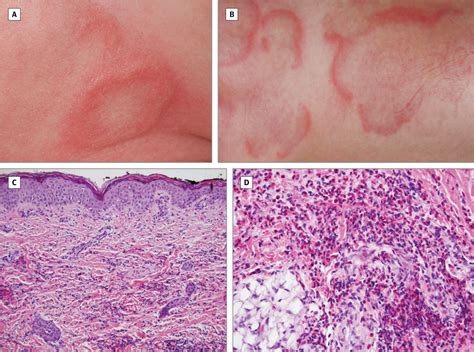 Recurring Diffuse Annular Erythematous Plaques In A Newborn