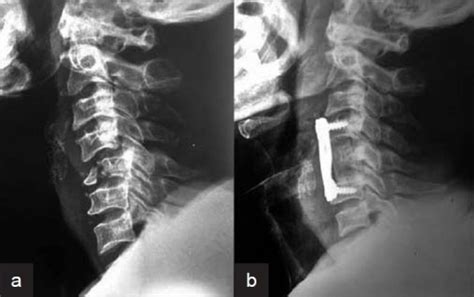 X Ray Cervical Spine Lateral View Showing A C5 Frac Open I