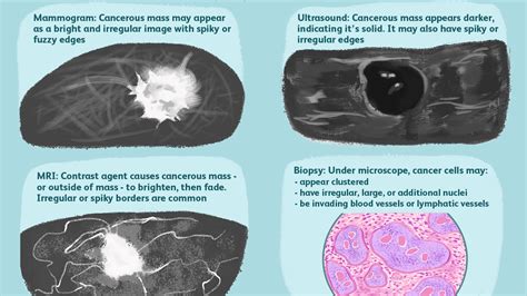 What Does Lobulated Nodule Mean Slidesharetrick